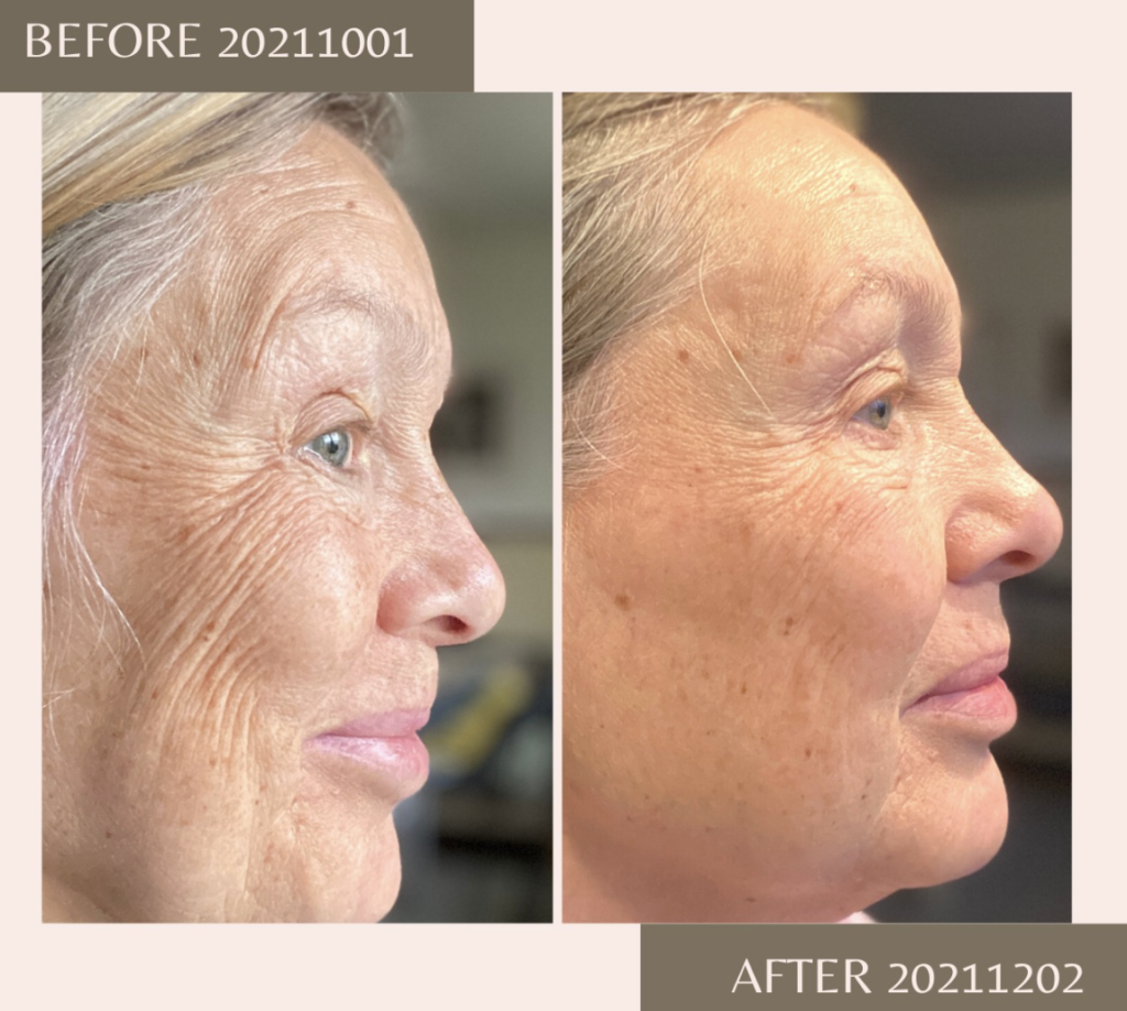 före-efter-kollagen-hud-hudvård-anti-aging-forever-living